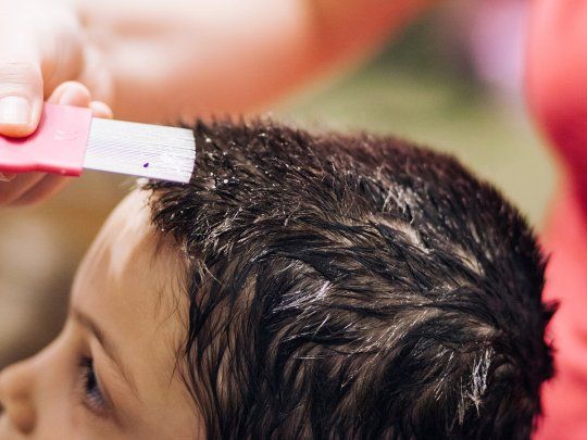 Cómo prevenir los piojos según la ciencia.&nbsp;