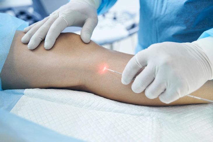 El endoláser es una de las técnicas más utilizadas para tratar las várices.