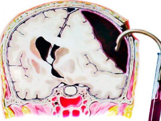 Cirugía hematomas subdurales.jpg