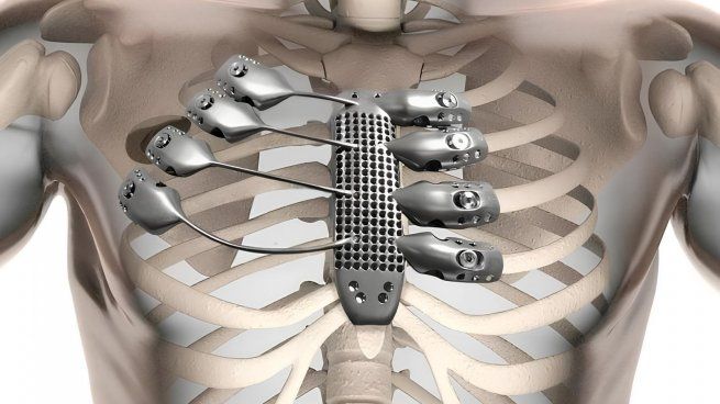 Ya se operaron más de 10 pacientes con este innovador sistema.