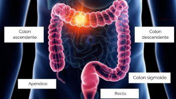 Tratamiento contra cáncer de colon.&nbsp;