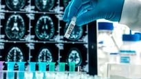 Estados Unidos aprobó el segundo medicamento contra el Alzheimer.