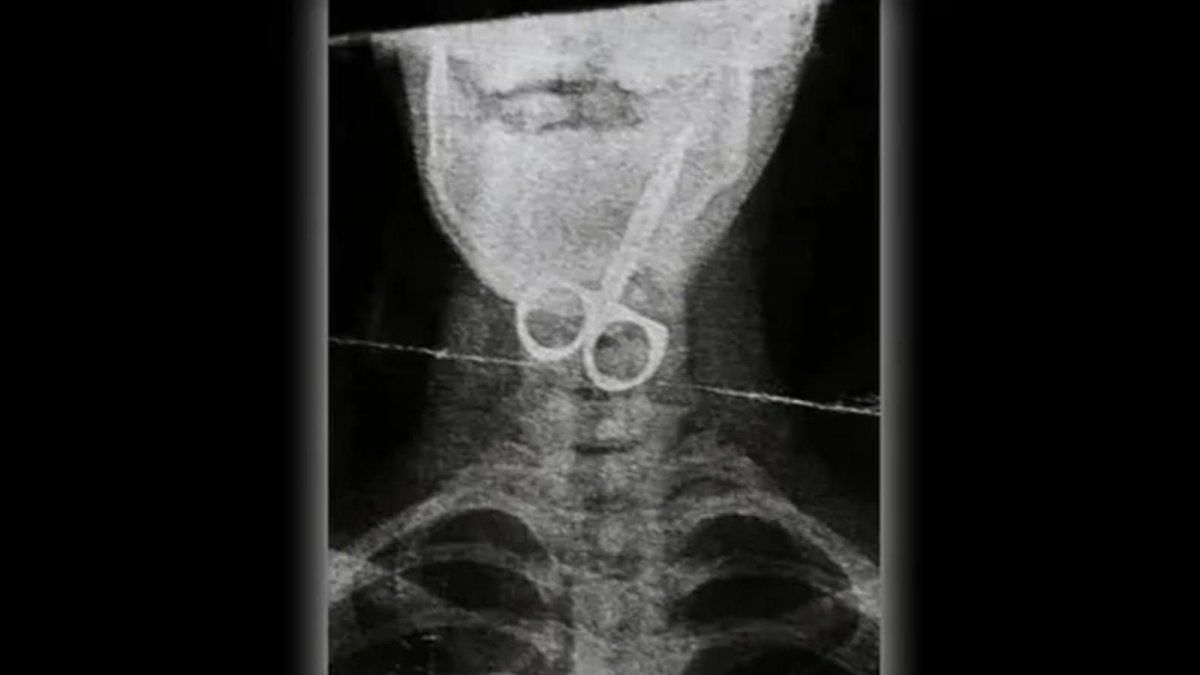 Horror in San Juan: a prisoner swallowed a scissors like “act of rebellion”