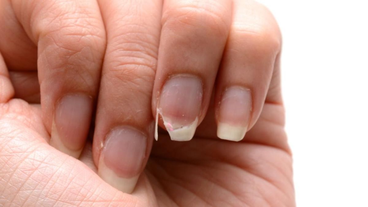 Health: this is the vitamin that the body lacks when nails break