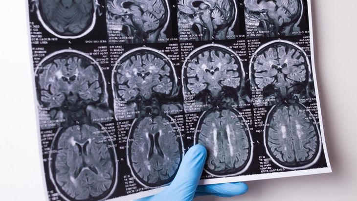 El glioblastoma es un tipo de tumor cerebral altamente agresivo. El glioblastoma es un tipo de tumor cerebral altamente agresivo.