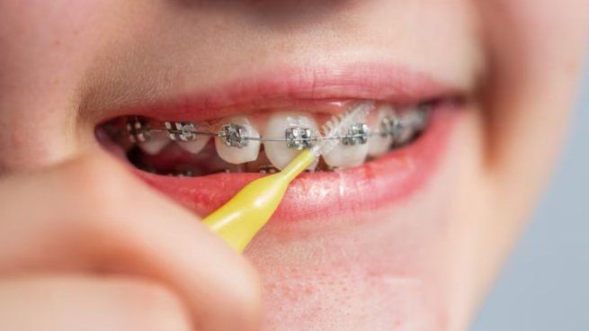 ANMAT prohíbe brackets falsificados por riesgos para la salud.