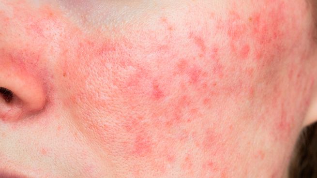Hay muchos tipos de rosácea, es importante que sea tratada para que no se convierta en algo grave.